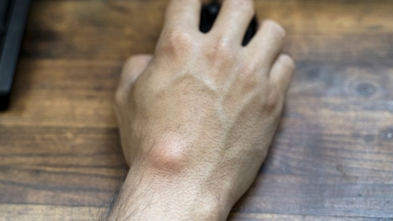Hand eines Mannes mit Knubbel unter der Haut hält Computermaus.