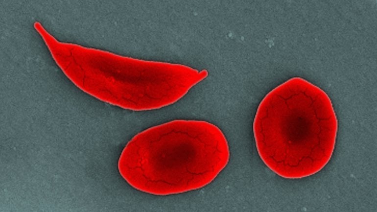 rote Blutkörperchen bei Sichelzellanämie