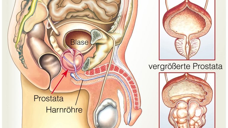 Prostatakrebs: Im Frühstadium oft ohne Symptome
