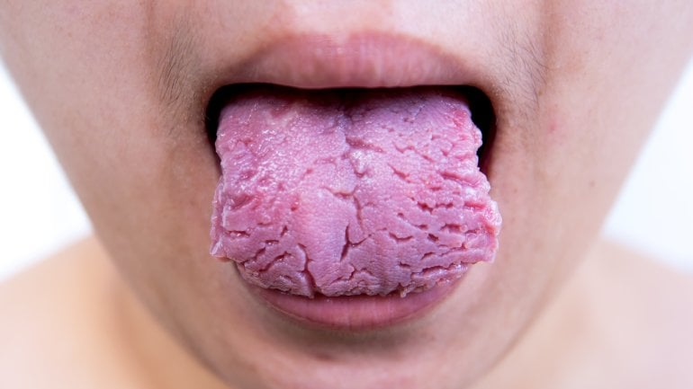 Starke Risse und Furchen in der Zunge