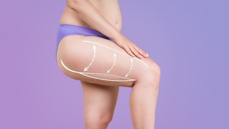 Bein einer Frau vor Fettabsaugung (Liposuktion). 