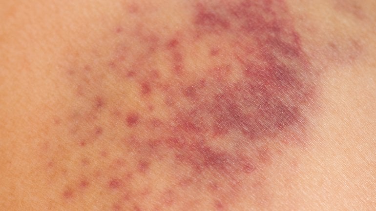 Blutvergiftung: Anzeichen auf der Haut