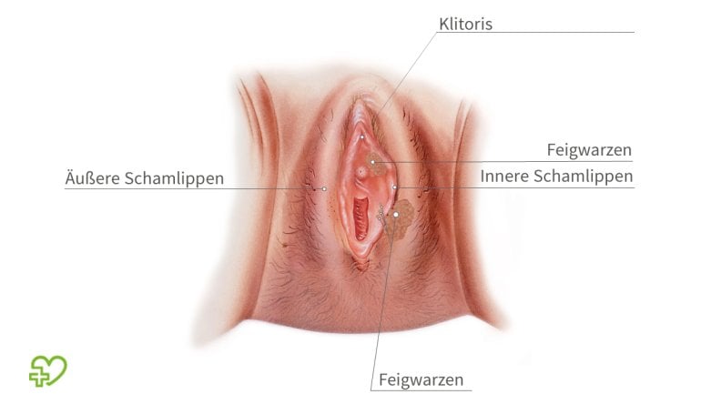 Bild: Feigwarzen bei der Frau erkennen an Vulva und Scheide