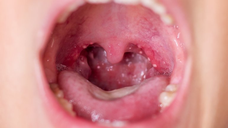 Bilder vom Anfangsstadium der Hand-Fuß-Mund-Krankheit: Bläschen im Mundbereich