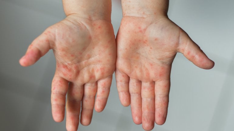 Hand-Fuß-Mund-Krankheit: Bilder vom Ausschlag bei Kindern