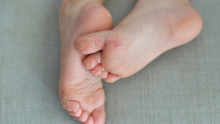 Bilder der Hand-Fuß-Mund-Krankheit: Haut schält sich ab