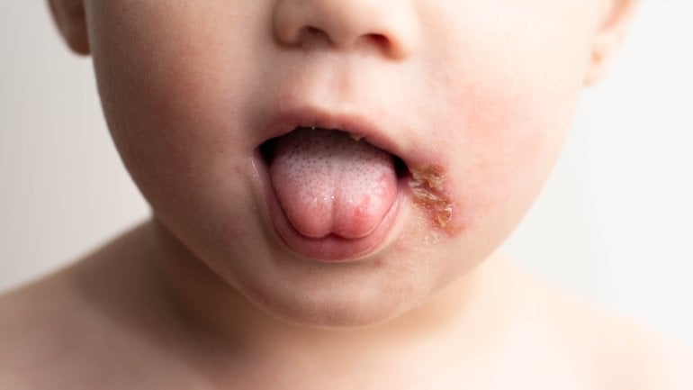 Hautausschlag bei Kindern erkennen: Herpes