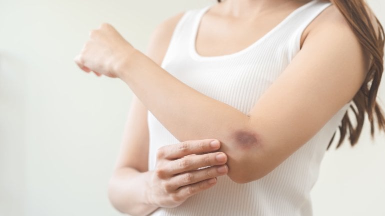 Leukämie: Flecken auf der Haut zählen zu Symptomen