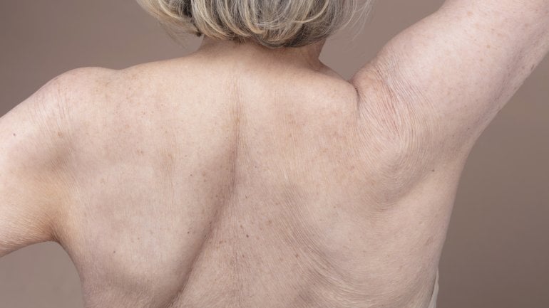 Symptom bei Osteoporose: Tannenbaumphänomen