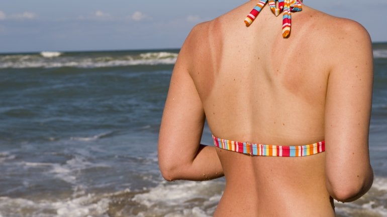 Das Bild zeigt eine Frau im Bikini von hinten am Meer mit Sonnenbrand.