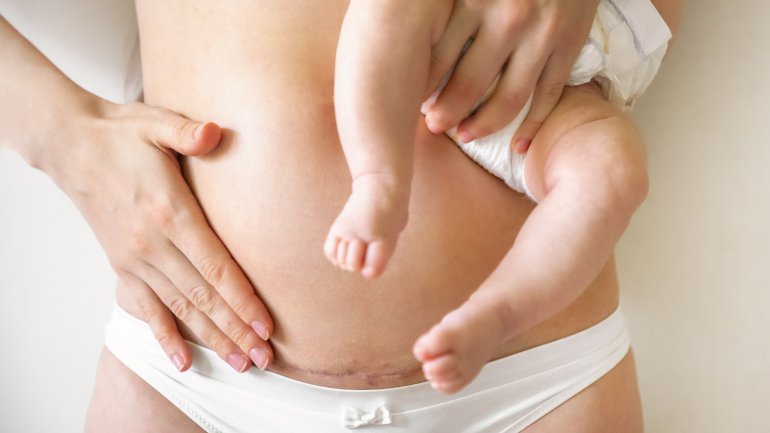 Eine Frau mit Kaiserschnittnarbe hält ein Baby