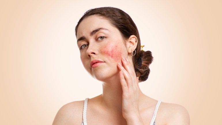 Scheibenförmige Hautläsionen können auf Lupus hindeuten