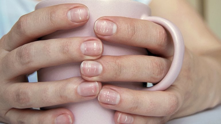 Frauenhände umklammern eine Tasse, auf den Nägeln sind deutliche weiße Flecken sichtbar