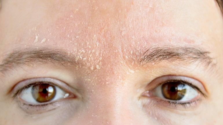 Neurodermitis: Schuppige Stellen an den Augen