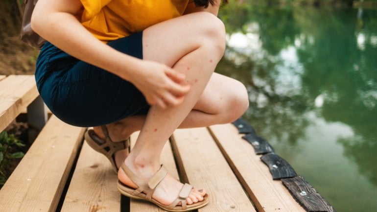 Eine Frau am Badesee kratzt sich an den Beinen, sie hat Ausschlag aufgrund von Zerkarien
