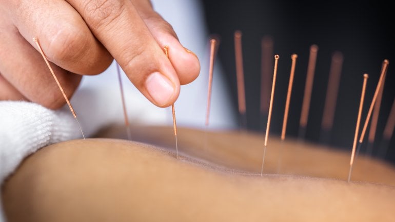 Man sieht eine*n Patient*in, an dem*der eine Akupunktur durchgeführt wird.