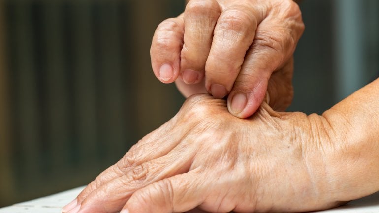 Ehlers-Danlos-Syndrom: Dehnbare Haut an einer Hand.