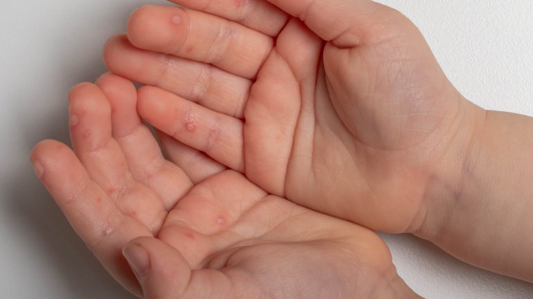 Hände von Kind mit Tomatengrippe.