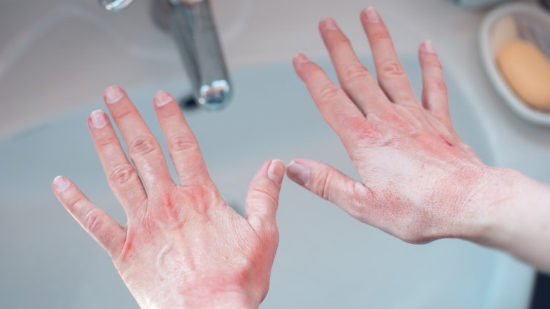 Frau hält Hände über Waschbecken und leidet unter Kälteallergie.