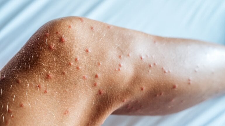 Bisse durch Sandmücken