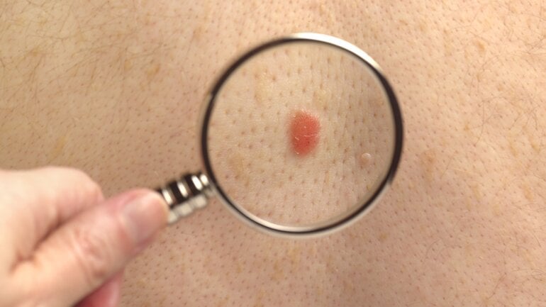 Schnell wachsender Knoten als Symptom