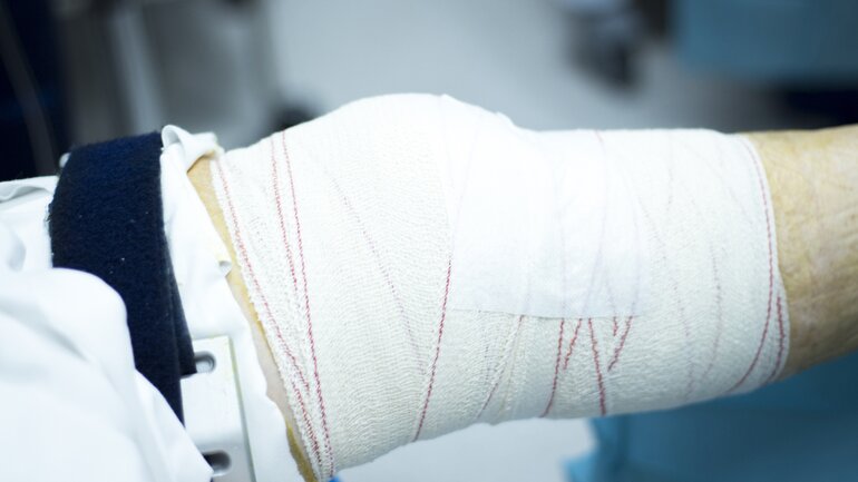 Behandlung einer Arthrose: gelenkversteifende Operation nur noch selten