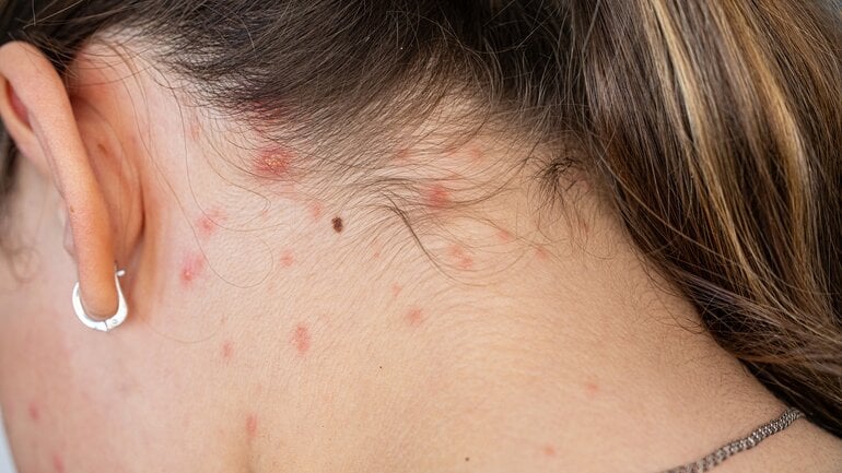 Gürtelrose auf der Kopfhaut: Gruppierte Bläschen und gerötete Haut