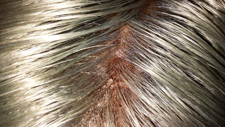 Allergisches Kontaktekzem: Rötung und Juckreiz nach Kontakt