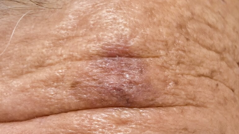 Erkrankungen der Kopfhaut: So sieht eine aktinische Keratose aus