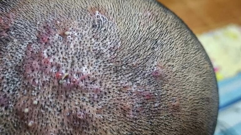 Follikulitis: Entzündete Haarwurzeln auf der Kopfhaut