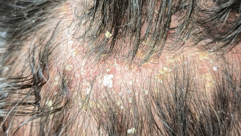 Seborrhoische Dermatitis: Gelbliche Schuppen und fettige Haut