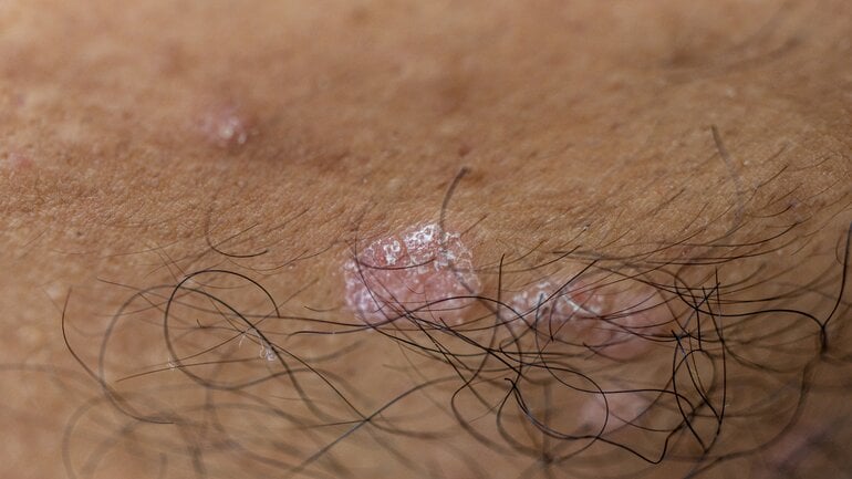 Erkrankungen der Kopfhaut: Bilder einer Ringelflechte