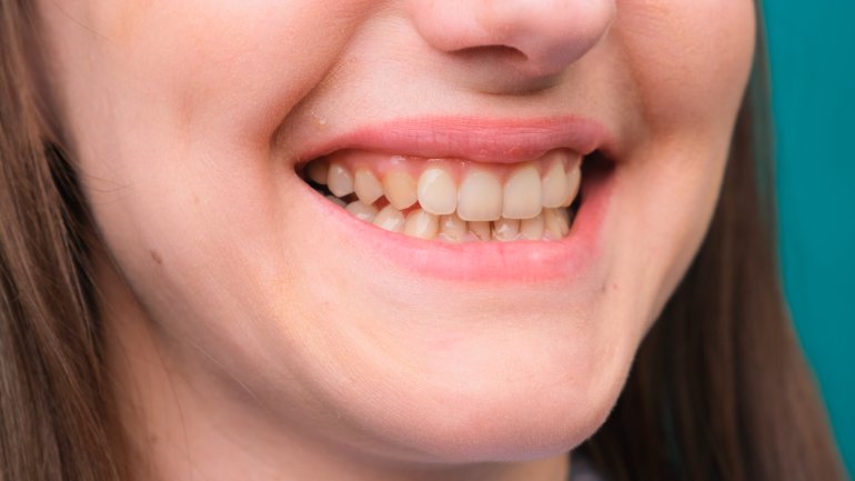 Frau lächelt und hat gelbe Zähne