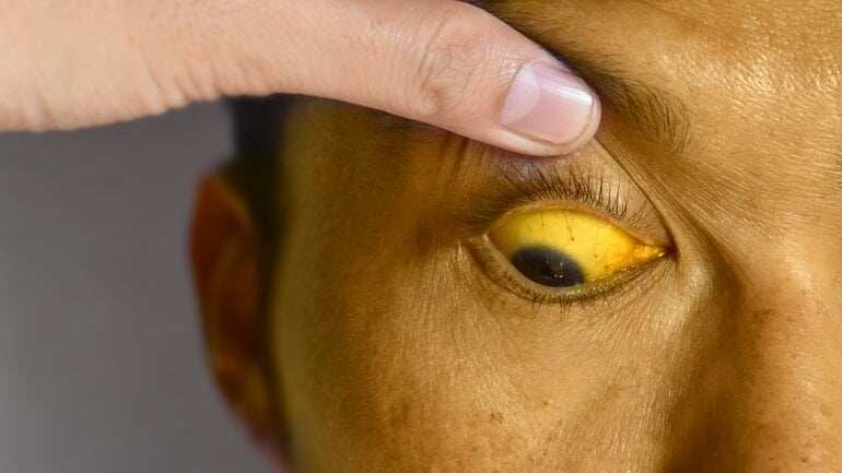 Leberzirrhose: Endstadium chronischer Lebererkrankungen