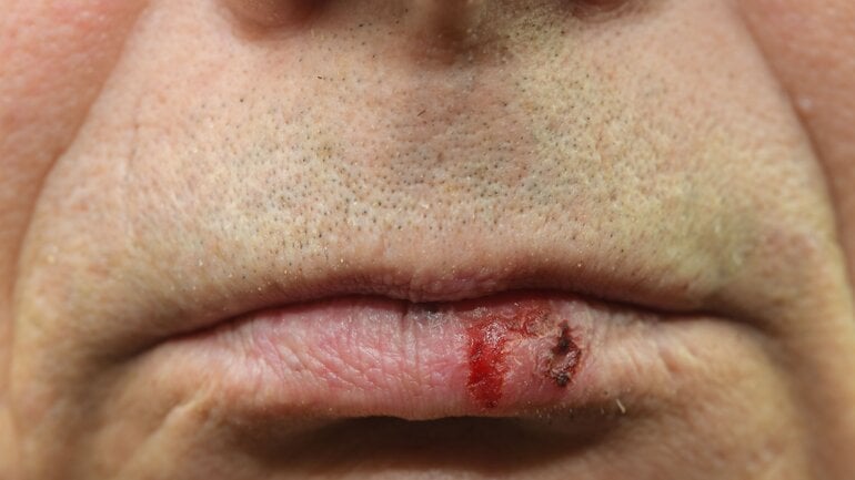 Lippenkrebs: Nicht heilendes Geschwür an der Lippe