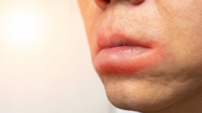 Tastbarer Knoten kann Symptom von Lippenkrebs sein