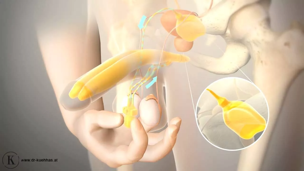 Penisprothese: Hilfe bei erektiler Dysfunktion