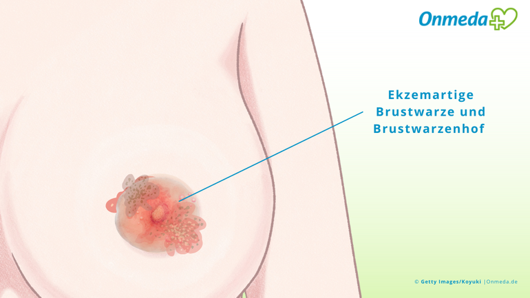 Ekzemartige Brustwarzenveränderung: Ist es ein Pagetkarzinom?