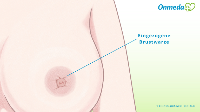 Neu auftretende Schlupfwarze: Was dahinterstecken kann