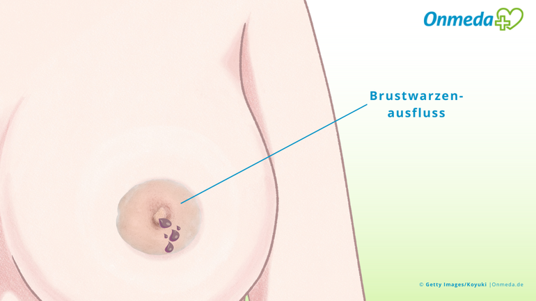 Was bedeutet brauner Ausfluss aus der Brustwarze?