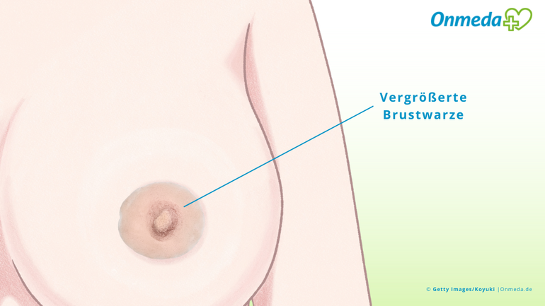 Große, dicke Nippel: Ist das normal?