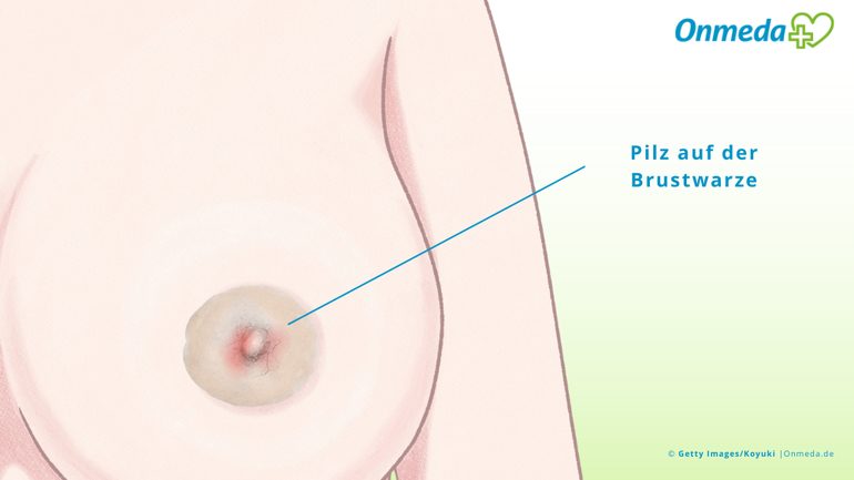 Pilz auf der Brustwarze: Stillende Frauen sind häufig betroffen