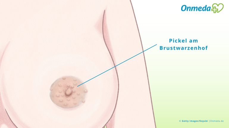 Pickel auf den Brustwarzen sind eine natürliche Erscheinung