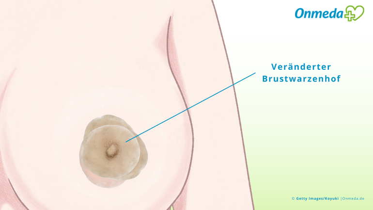 Ein dunkler und breiter Brustwarzenhof ist nur selten gefährlich