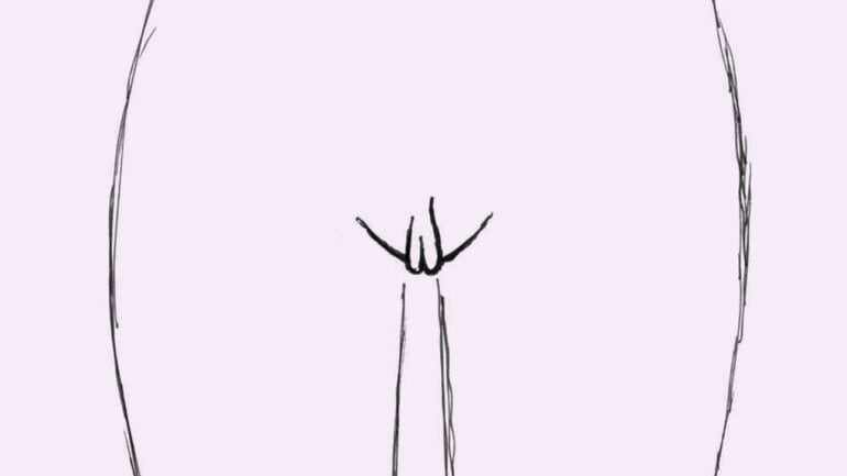 Typ 2: Hervortretende innere Labien