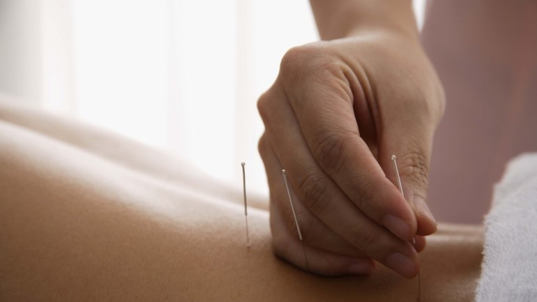 Das Bild zeigt Akupunkturnadeln, die gesetzt werden.