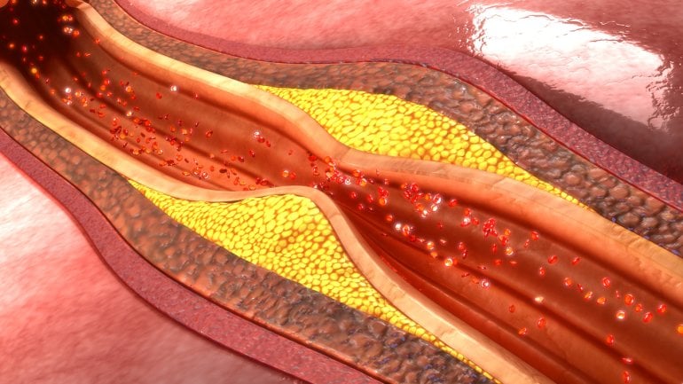 Die schematische Darstellung zeigt einen Längschnitt durch ein Blutgefäß, das durch Arteriosklerose verengt und verdickt ist..