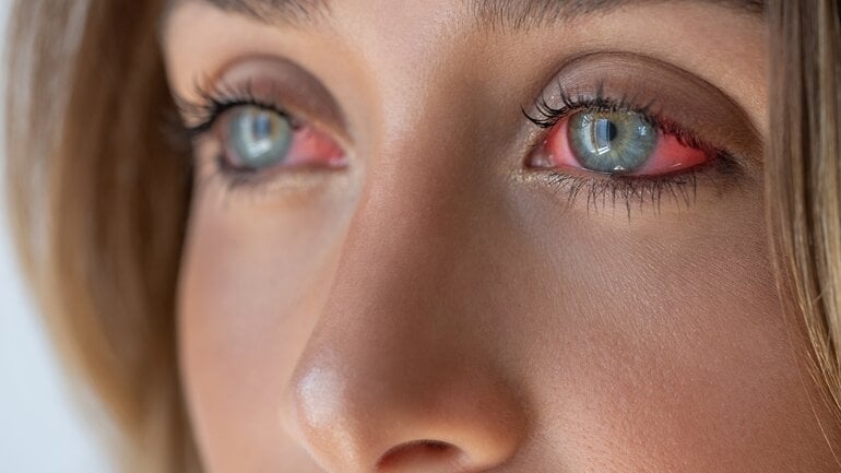 Gerötetes Auge: Häufig erstes Anzeichen einer Augengrippe