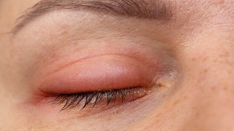 Augengrippe: Geschwollene Lider und gereizte Bindehaut sind Symptome