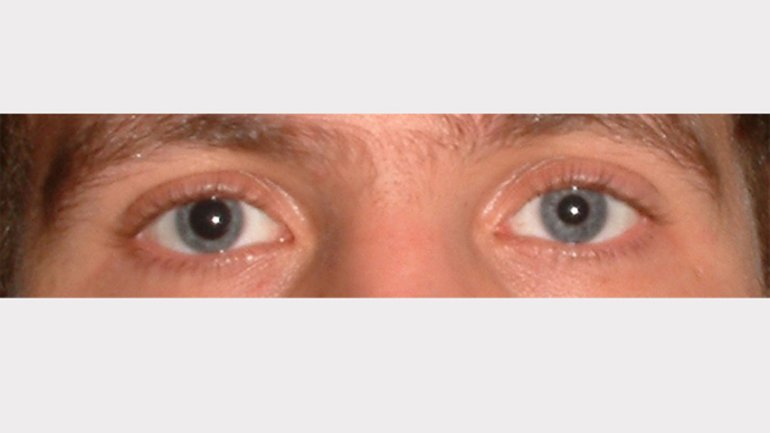 Was bedeuten unterschiedlich große pupillen